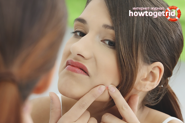 Comment se débarrasser de l'habitude d'écraser l'acné