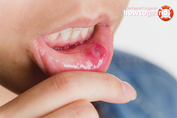 Wie man Stomatitis loswird