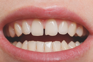 How to remove the gap between the front teeth