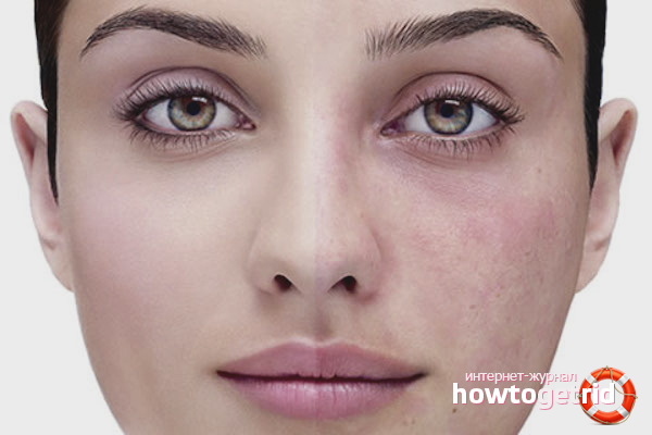 So entfernen Sie Kapillaren im Gesicht