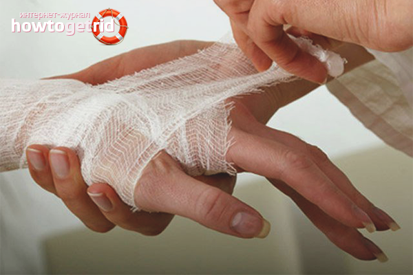 Comment se débarrasser de la douleur après une brûlure chimique