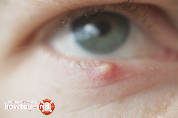 Comment traiter l'orge dans les yeux