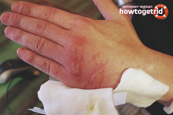 Comment soulager les brûlures