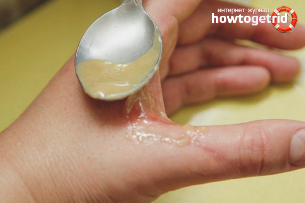 Remèdes populaires contre les brûlures