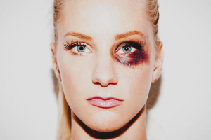 How to reduce a black eye