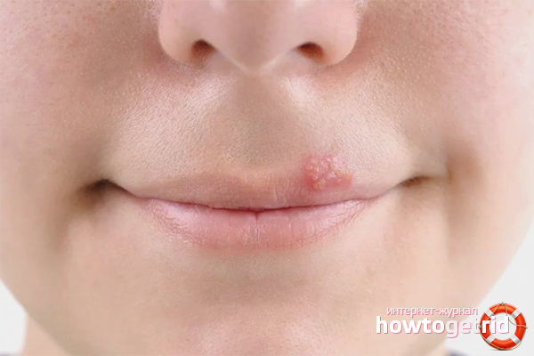 Wie man Fieberbläschen auf den Lippen heilt