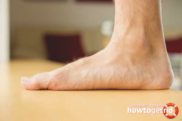 Wie man Plattfüße behandelt