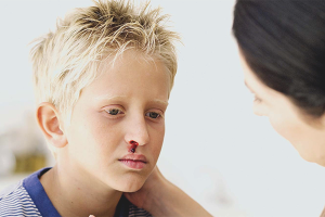 Epistaxis in children