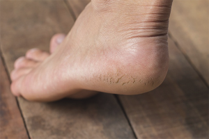 How to heal cracked heels