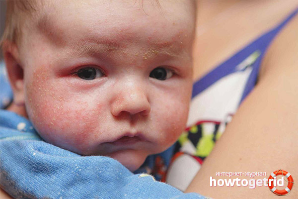 Diathesis on the cheeks of a child
