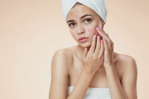 Hormonal acne in women