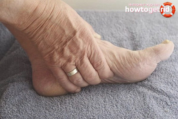 Behandlung von Beinödemen bei älteren Menschen