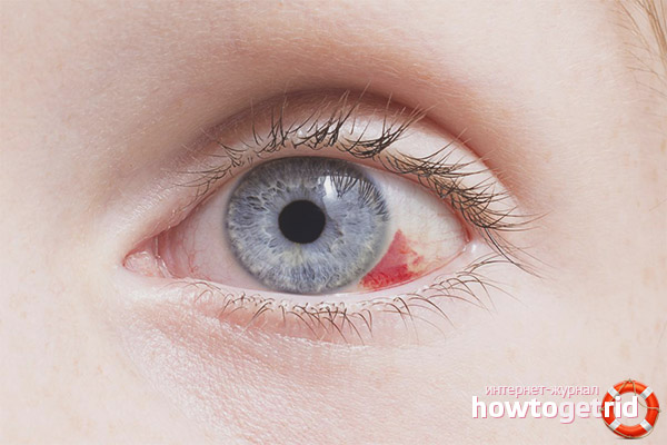 Platzen Sie das Gefäß im Auge