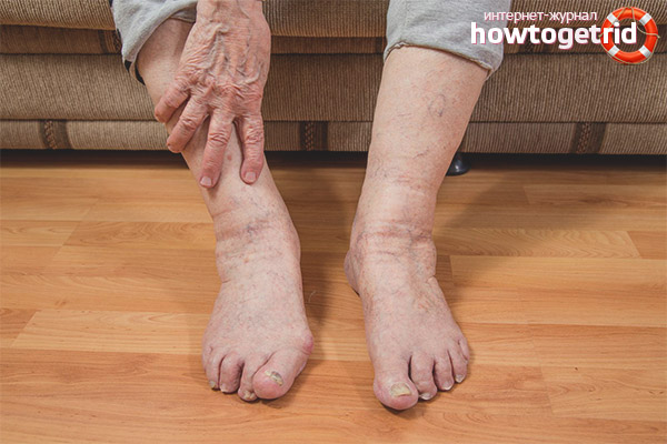 Beinschwellung bei älteren Menschen