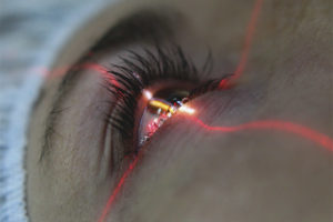 Laser vision correction