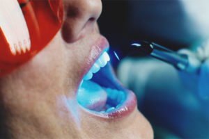 Laser teeth whitening