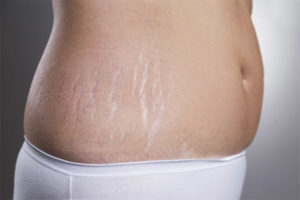 Is it possible to remove stretch marks after childbirth?